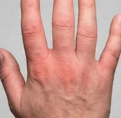 Red, swollen hand of a patient with autoimmune symptoms from undifferentiated connective tissue disease