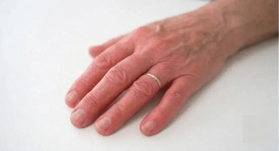 Hand with reddened, tight skin from systemic sclerosis